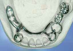 frameprothese
