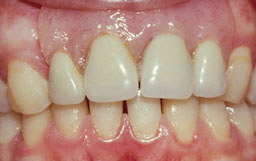 plaatprothese gebit